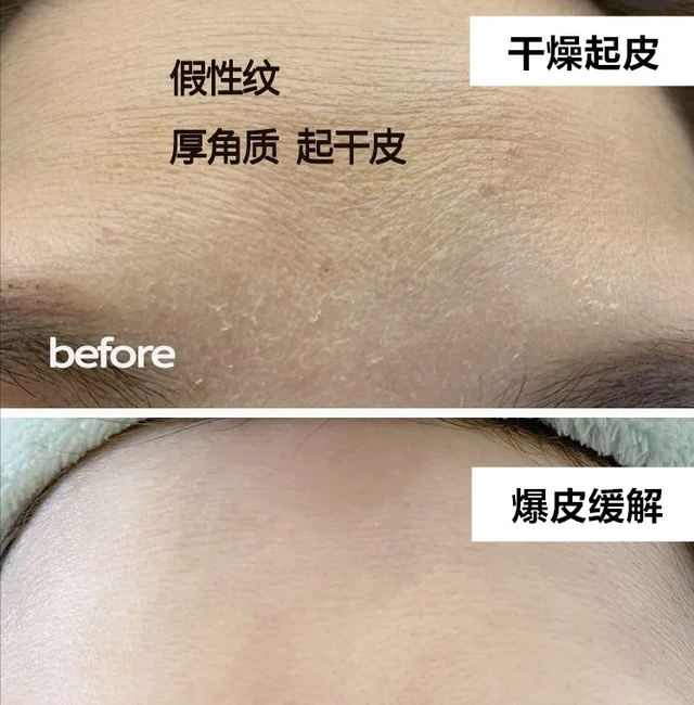 换季期脸皮干燥起皮，该怎么办？