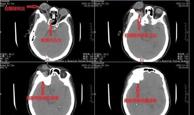 65岁妇女眼球突出，检查后发现是罕见颅底沟通脑膜瘤