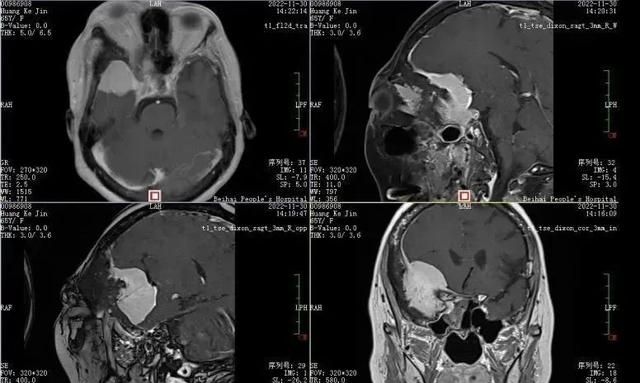 65岁妇女眼球突出，检查后发现是罕见颅底沟通脑膜瘤