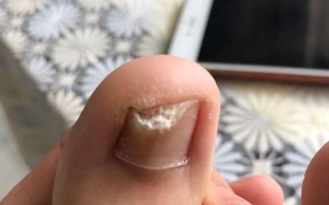 灰指甲的初期症状,小孩灰指甲的初期症状