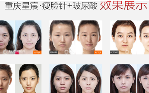 瘦脸针多少钱一次双眼皮手术,瘦脸针多少钱一次有效