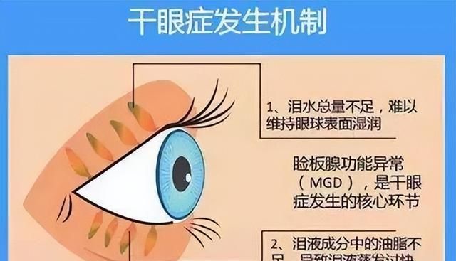眼睛干怎么办？细扒几款网红眼药水