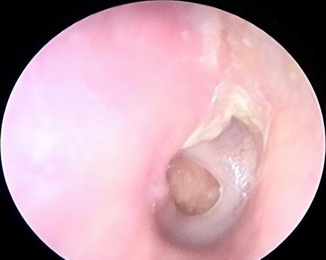 中耳炎鼓膜穿孔，耳内镜微创可根治