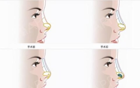 隆鼻手术如何选择切口,耳软骨隆鼻怎么能让耳朵不留疤