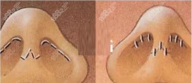 关于隆鼻的切口，想要不留疤选哪种切口最好？看你的基础适合哪个