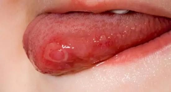 让人闹心的口腔溃疡，这些老偏方你用过吗？