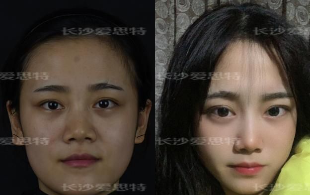 面部雀斑适合做光子嫩肤仪还是皮秒激光仪