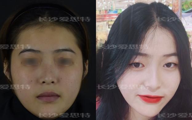 面部雀斑适合做光子嫩肤仪还是皮秒激光仪