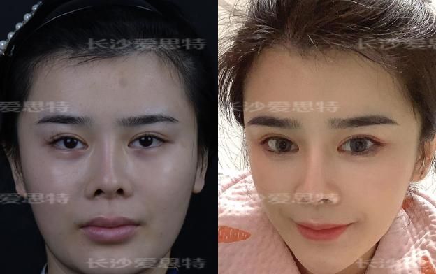 面部雀斑适合做光子嫩肤仪还是皮秒激光仪