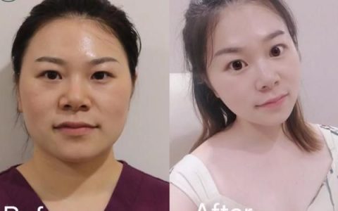 失败的瘦脸针脸部凹陷是否能恢复