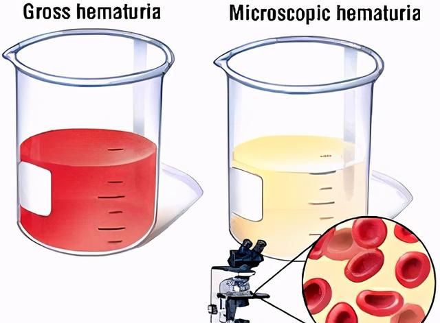 体检为什么总是尿隐血阳性？今天来说个明白