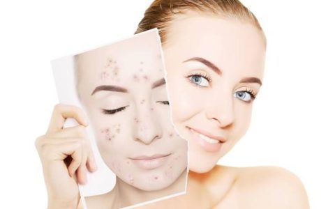 如何快速去青春痘痘(青春痘快速消除方法男)