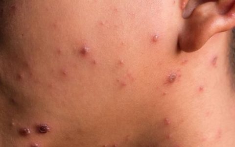 注意!这不是海鲜过敏,是二期梅毒过敏吗