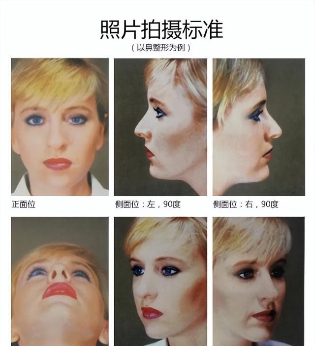 20岁姑娘不远万里来京隆鼻，7天获得自然妈生鼻，手术细节大公开