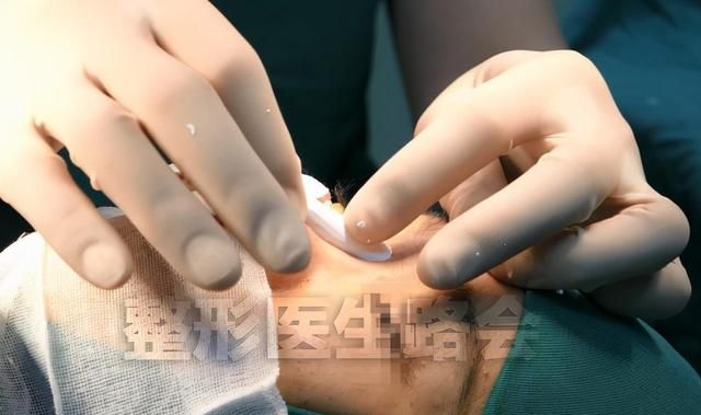 20岁姑娘不远万里来京隆鼻，7天获得自然妈生鼻，手术细节大公开