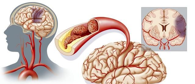 抗脑缺血、抗血栓、降血黏度，5种治疗脑梗死的中成药，您要知道