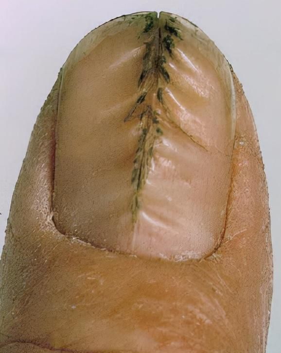 对图自查！指甲长出褶皱or凹点是得了什么大病吗？