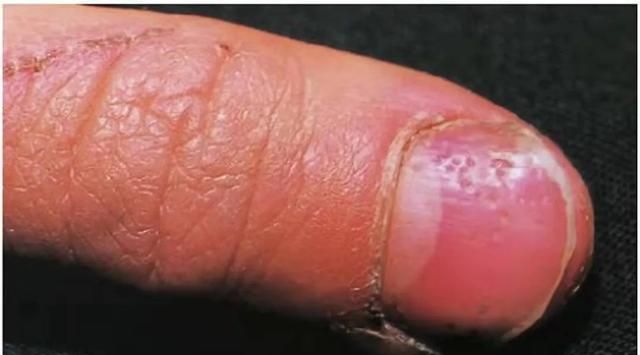 对图自查！指甲长出褶皱or凹点是得了什么大病吗？