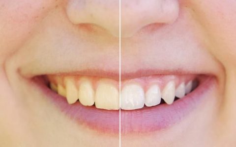 如何解决黄牙一次见效,有没有简单的去黄牙办法