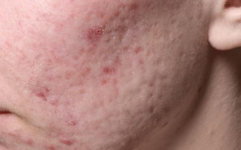 痘坑怎么修复和维护(祛痘印修复痘坑排行榜第一名)