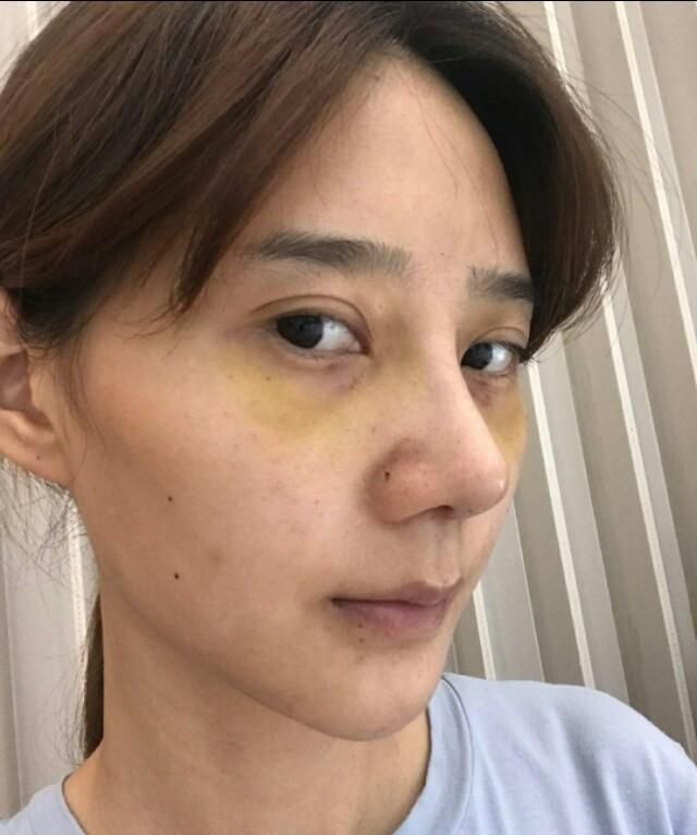 花了3w5，矫正我的歪鼻