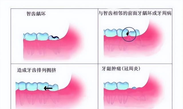 拔2颗牙花了1800，医生到底是为了治我的牙，还是为了抢我的钱？