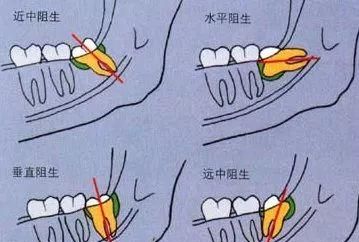 不长智齿真的不正常吗？