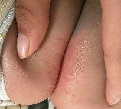 一条简单粗暴的绝招，教你治好宝宝红屁股