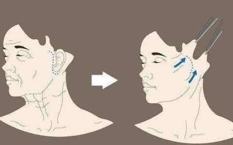 面部除皱术分为几个部位