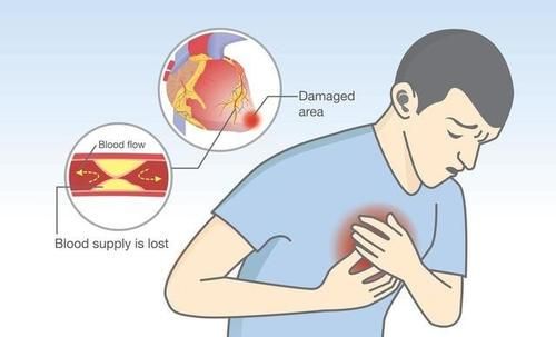 急性心梗保守治疗能活多久(得过急性心梗的人能活多久)图1