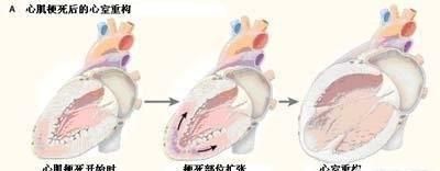 急性心梗保守治疗能活多久(得过急性心梗的人能活多久)图6