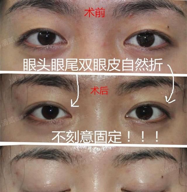 双眼皮太长好显老！一笑还有鱼尾纹！修复可以改短吗？