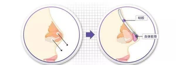 隆鼻术的术后需要注意什么？假体隆鼻可以一辈子吗？