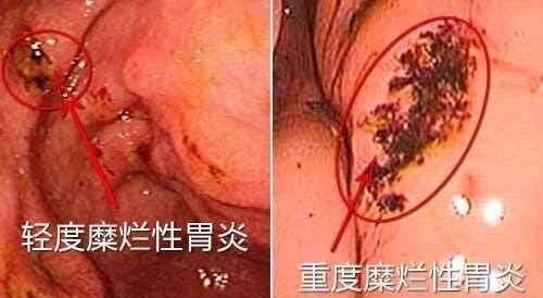 复方胃宁胶囊能治糜烂性胃炎吗,复方胃宁胶囊治萎缩性胃炎吗图4