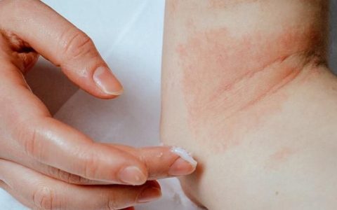 患湿疹的孩子,5种情况,家长需要引起重视吗