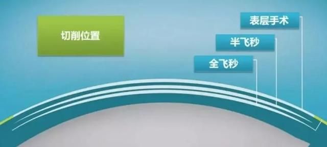 跟眼镜说拜拜！南京近视手术 全飞秒变EK 过程太曲折 附花费清单