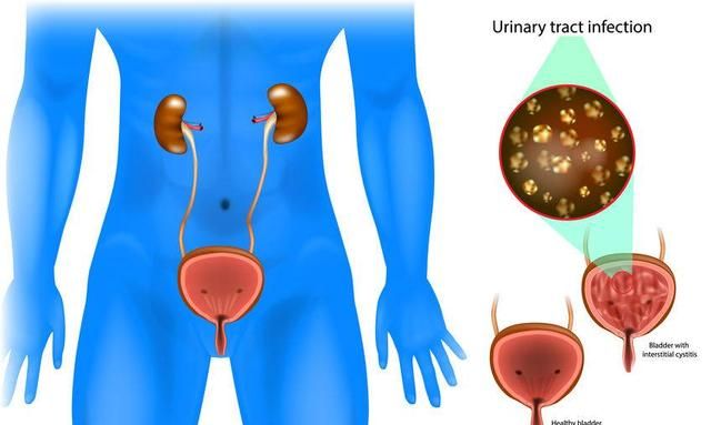 膀胱炎发生时，身体会发出5个信号，仔细观察，发现后及时就医