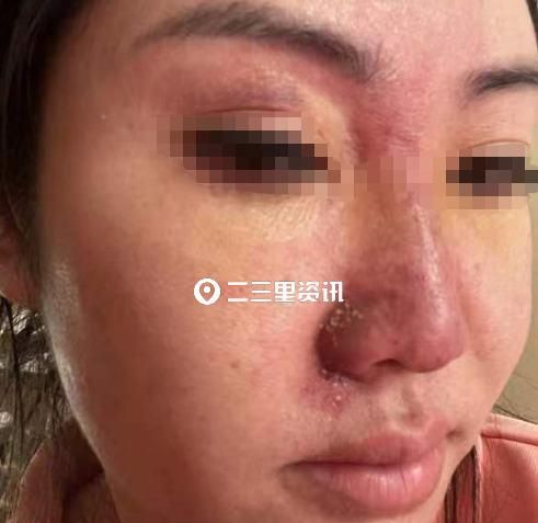 花六万元在医疗美容机构做鼻部微整形，术后出现眼睛模糊头疼？