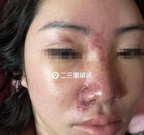 花六万元在医疗美容机构做鼻部微整形，术后出现眼睛模糊头疼？