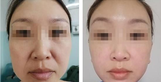 不了解"中下面部微创提升手术"？12个问答，帮您解决一些实际问题