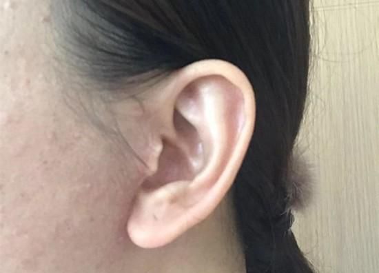 不了解"中下面部微创提升手术"？12个问答，帮您解决一些实际问题