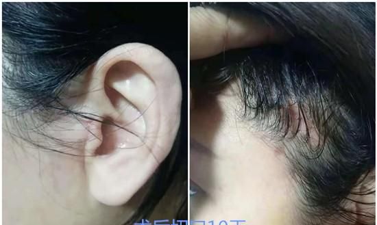 不了解"中下面部微创提升手术"？12个问答，帮您解决一些实际问题
