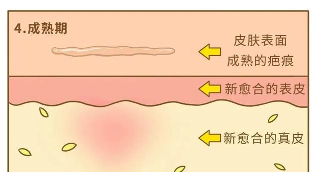 祛疤有个黄金期，错过了就真来不及了