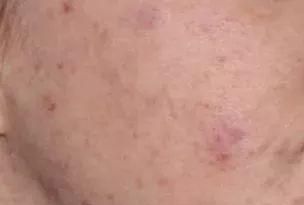 光子嫩肤，助您重返颜值巅峰