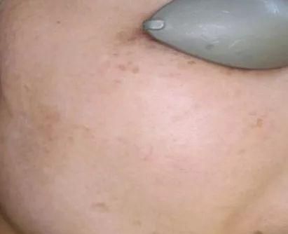 光子嫩肤，助您重返颜值巅峰