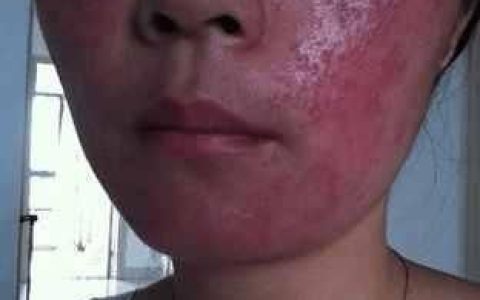 激光去红血丝到底好不好,红血丝激光后多久会恢复
