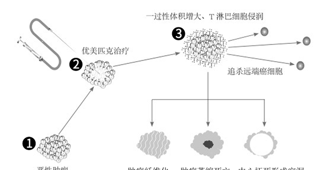 伽马刀，和不手术治疗肿瘤的缓释库方法对比，有哪些优缺点？