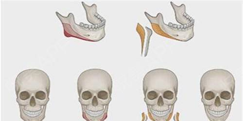 行内人怎么看下颌角手术？