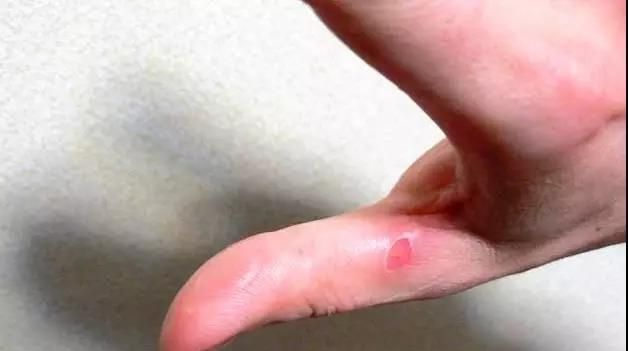 被开水烫伤了怎么办？一分钟教你快速急救