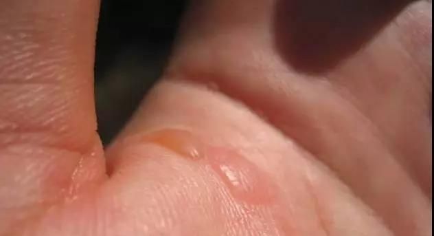 被开水烫伤了怎么办？一分钟教你快速急救